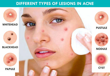 South Moon Eczema Cream