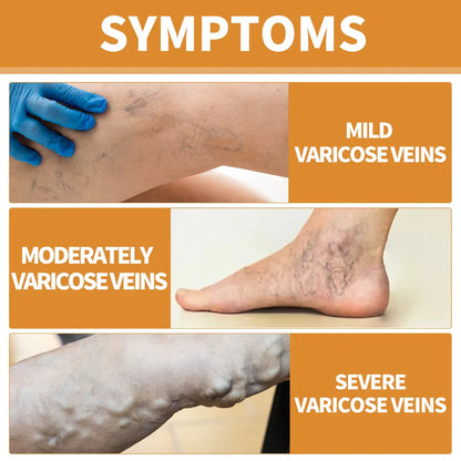 Turmeric Varicose Vein Relief
