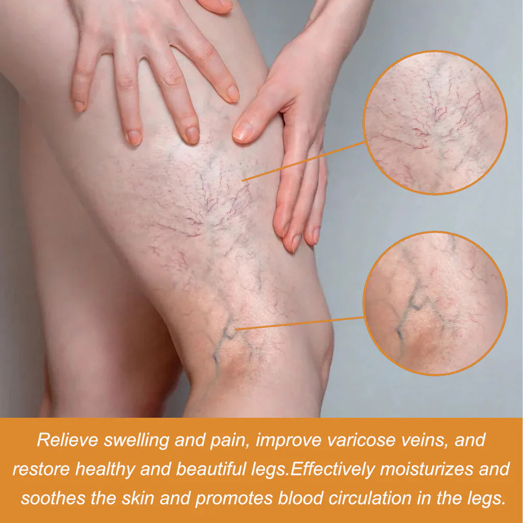 Turmeric Varicose Vein Relief
